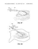 MINIMALLY-INVASIVE METHODS FOR IMPLANTING OBESITY TREATMENT DEVICES diagram and image