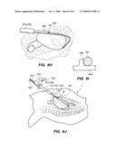 MINIMALLY-INVASIVE METHODS FOR IMPLANTING OBESITY TREATMENT DEVICES diagram and image