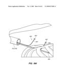 MINIMALLY-INVASIVE METHODS FOR IMPLANTING OBESITY TREATMENT DEVICES diagram and image