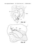 MINIMALLY-INVASIVE METHODS FOR IMPLANTING OBESITY TREATMENT DEVICES diagram and image