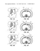 MINIMALLY-INVASIVE METHODS FOR IMPLANTING OBESITY TREATMENT DEVICES diagram and image