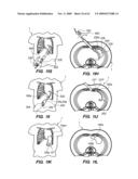 MINIMALLY-INVASIVE METHODS FOR IMPLANTING OBESITY TREATMENT DEVICES diagram and image