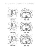 MINIMALLY-INVASIVE METHODS FOR IMPLANTING OBESITY TREATMENT DEVICES diagram and image