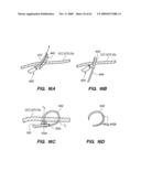 MINIMALLY-INVASIVE METHODS FOR IMPLANTING OBESITY TREATMENT DEVICES diagram and image