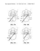 MINIMALLY-INVASIVE METHODS FOR IMPLANTING OBESITY TREATMENT DEVICES diagram and image