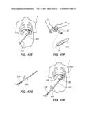 MINIMALLY-INVASIVE METHODS FOR IMPLANTING OBESITY TREATMENT DEVICES diagram and image