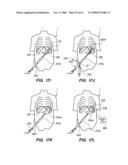 MINIMALLY-INVASIVE METHODS FOR IMPLANTING OBESITY TREATMENT DEVICES diagram and image