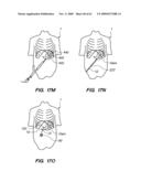 MINIMALLY-INVASIVE METHODS FOR IMPLANTING OBESITY TREATMENT DEVICES diagram and image