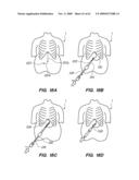 MINIMALLY-INVASIVE METHODS FOR IMPLANTING OBESITY TREATMENT DEVICES diagram and image