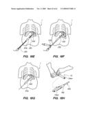 MINIMALLY-INVASIVE METHODS FOR IMPLANTING OBESITY TREATMENT DEVICES diagram and image