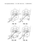 MINIMALLY-INVASIVE METHODS FOR IMPLANTING OBESITY TREATMENT DEVICES diagram and image