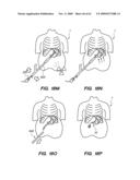 MINIMALLY-INVASIVE METHODS FOR IMPLANTING OBESITY TREATMENT DEVICES diagram and image