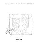 MINIMALLY-INVASIVE METHODS FOR IMPLANTING OBESITY TREATMENT DEVICES diagram and image