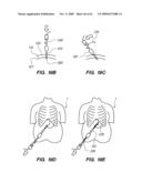 MINIMALLY-INVASIVE METHODS FOR IMPLANTING OBESITY TREATMENT DEVICES diagram and image