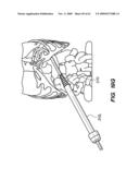 MINIMALLY-INVASIVE METHODS FOR IMPLANTING OBESITY TREATMENT DEVICES diagram and image