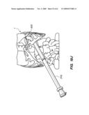 MINIMALLY-INVASIVE METHODS FOR IMPLANTING OBESITY TREATMENT DEVICES diagram and image