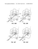 MINIMALLY-INVASIVE METHODS FOR IMPLANTING OBESITY TREATMENT DEVICES diagram and image