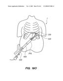 MINIMALLY-INVASIVE METHODS FOR IMPLANTING OBESITY TREATMENT DEVICES diagram and image