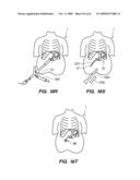 MINIMALLY-INVASIVE METHODS FOR IMPLANTING OBESITY TREATMENT DEVICES diagram and image