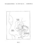 STENT FOR IRRIGATION AND DELIVERY OF MEDICATION diagram and image