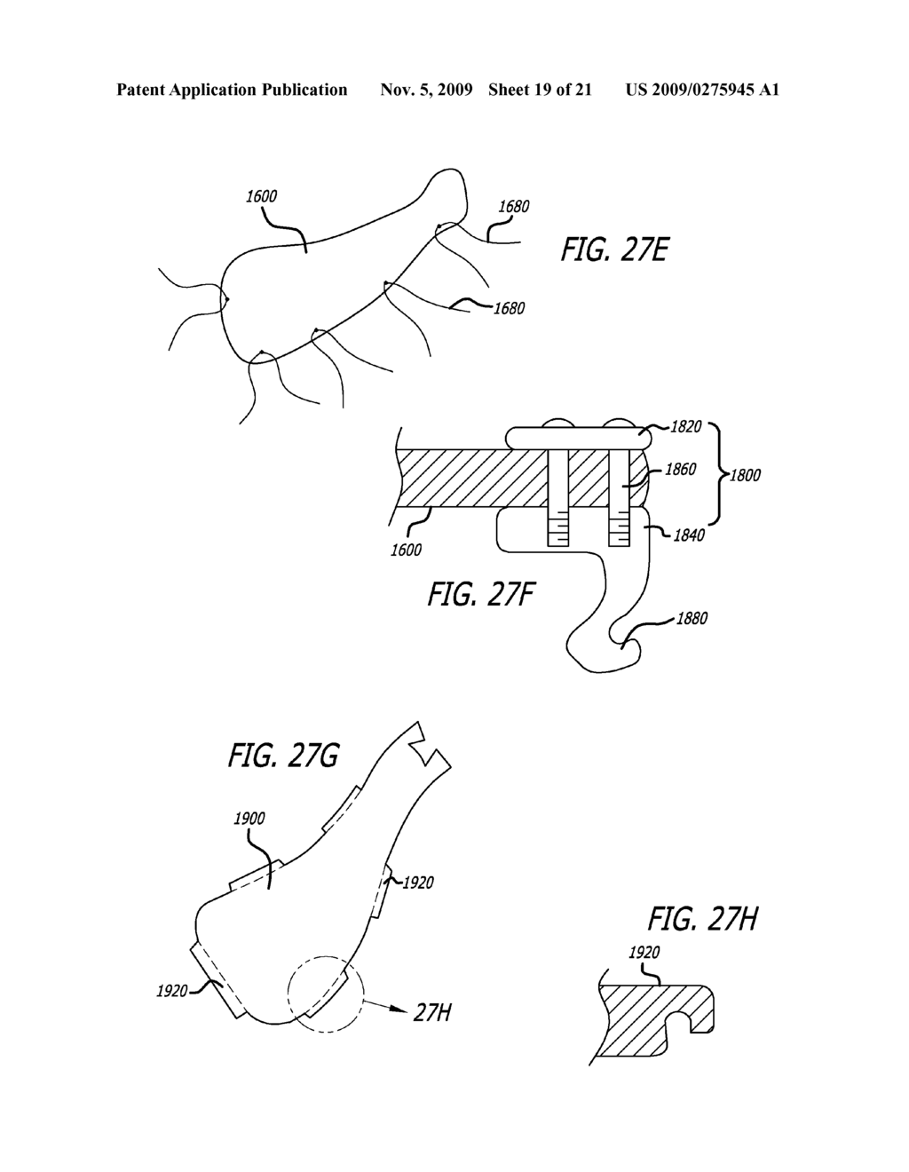 SHEATHS FOR EXTRA-ARTICULAR IMPLANTABLE SYSTEMS - diagram, schematic, and image 20