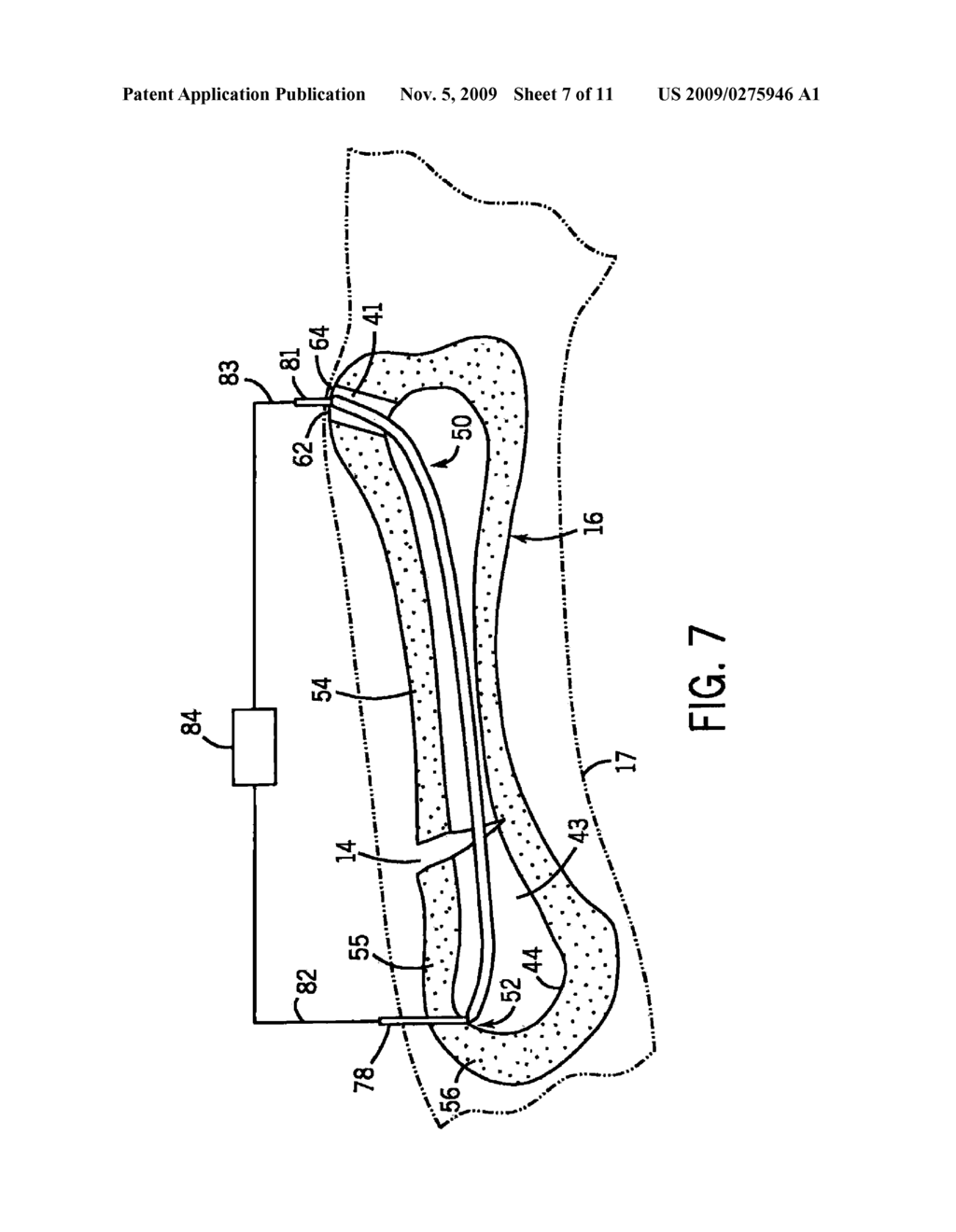 Intramedullary Fixation Device for Small Bone Fractures - diagram, schematic, and image 08