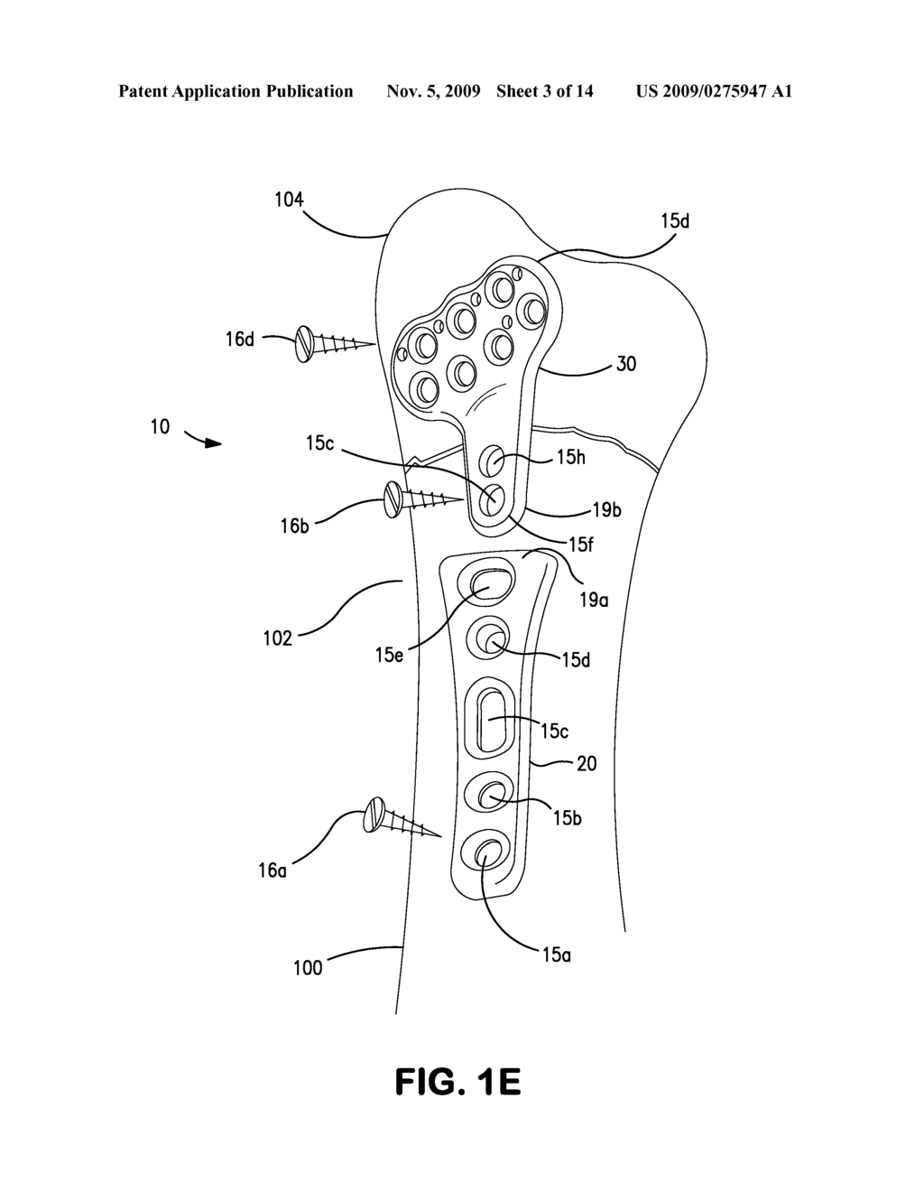 BONE PLATE SYSTEM FOR BONE RESTORATION AND METHODS OF USE THEREOF - diagram, schematic, and image 04