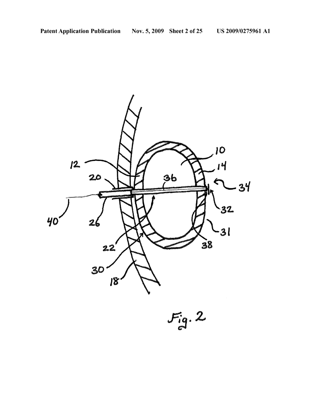 GASTRIC VOLUME REDUCTION USING ANTERIOR TO POSTERIOR WALL JUNCTIONS - diagram, schematic, and image 03