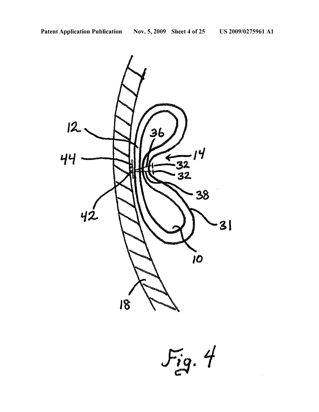 GASTRIC VOLUME REDUCTION USING ANTERIOR TO POSTERIOR WALL JUNCTIONS - diagram, schematic, and image 05