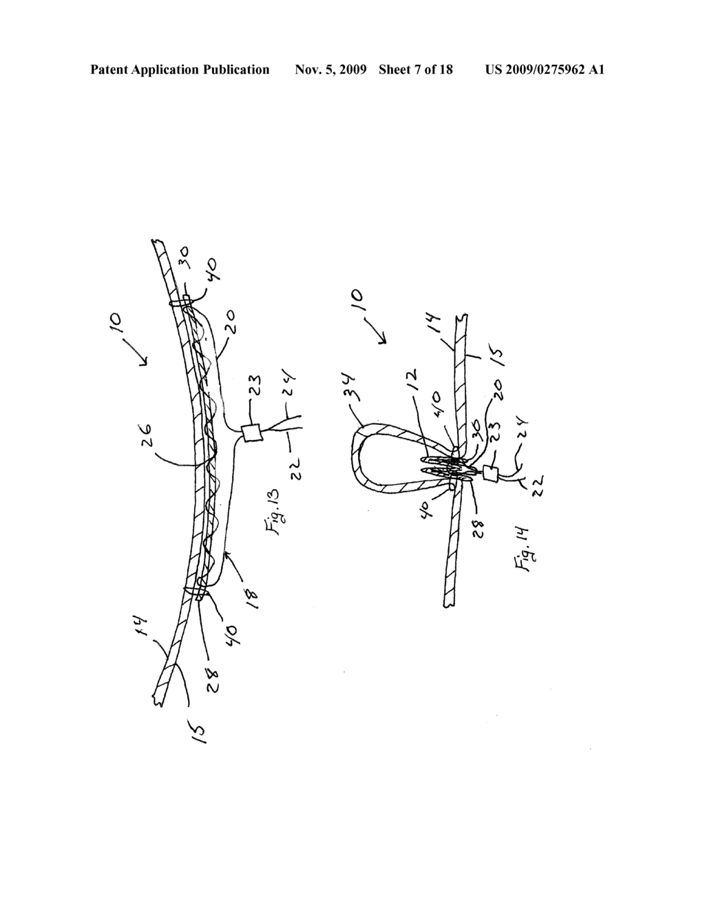 TISSUE APPOSITION METHOD AND DEVICE INVOLVING SHEETS WITH INTEGRATED TENSIONING SYSTEM - diagram, schematic, and image 08