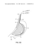 DEVICES AND SYSTEMS FOR GASTRIC VOLUME CONTROL diagram and image