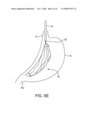 DEVICES AND SYSTEMS FOR GASTRIC VOLUME CONTROL diagram and image