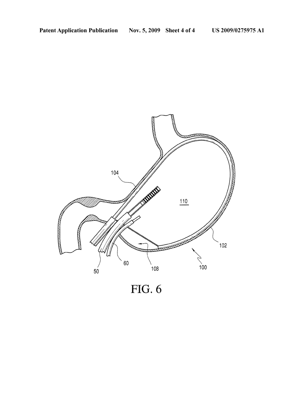 GASTRIC COIL MANIPULATOR - diagram, schematic, and image 05