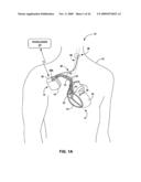 TECHNIQUES FOR PLACING MEDICAL LEADS FOR ELECTRICAL STIMULATION OF NERVE TISSUE diagram and image