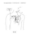 TECHNIQUES FOR PLACING MEDICAL LEADS FOR ELECTRICAL STIMULATION OF NERVE TISSUE diagram and image