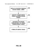 TECHNIQUES FOR PLACING MEDICAL LEADS FOR ELECTRICAL STIMULATION OF NERVE TISSUE diagram and image