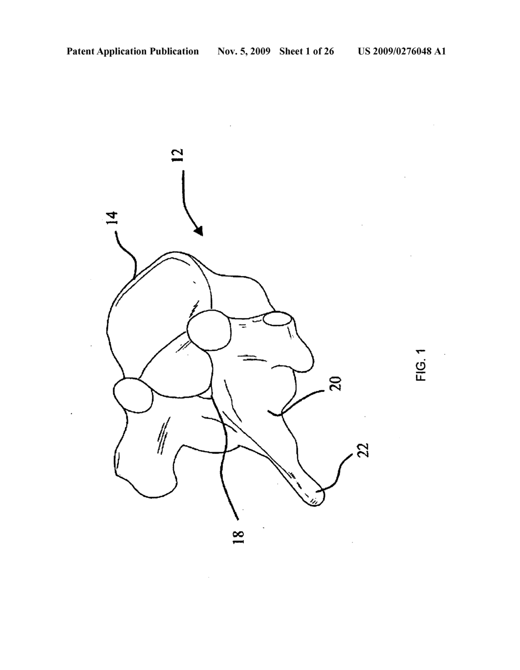 DEVICES AND METHOD FOR BILATERAL SUPPORT OF A COMPRESSION-FRACTURED VERTEBRAL BODY - diagram, schematic, and image 02