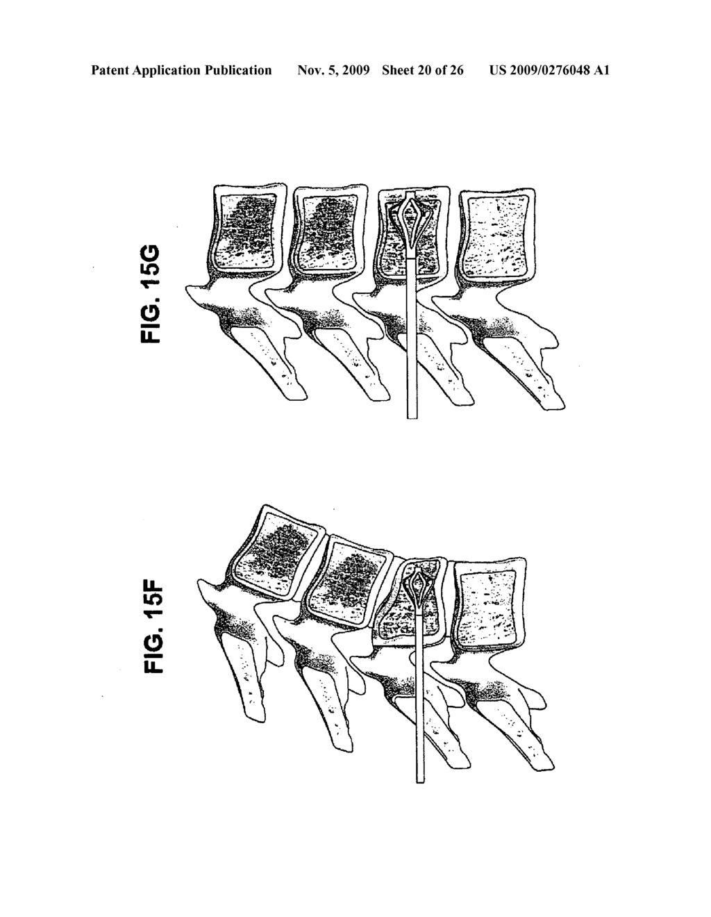 DEVICES AND METHOD FOR BILATERAL SUPPORT OF A COMPRESSION-FRACTURED VERTEBRAL BODY - diagram, schematic, and image 21