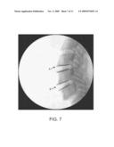 Polyaryletherketone Artificial Intervertebral Disc diagram and image