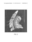 Polyaryletherketone Artificial Intervertebral Disc diagram and image