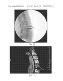 Polyaryletherketone Artificial Intervertebral Disc diagram and image