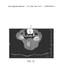 Polyaryletherketone Artificial Intervertebral Disc diagram and image