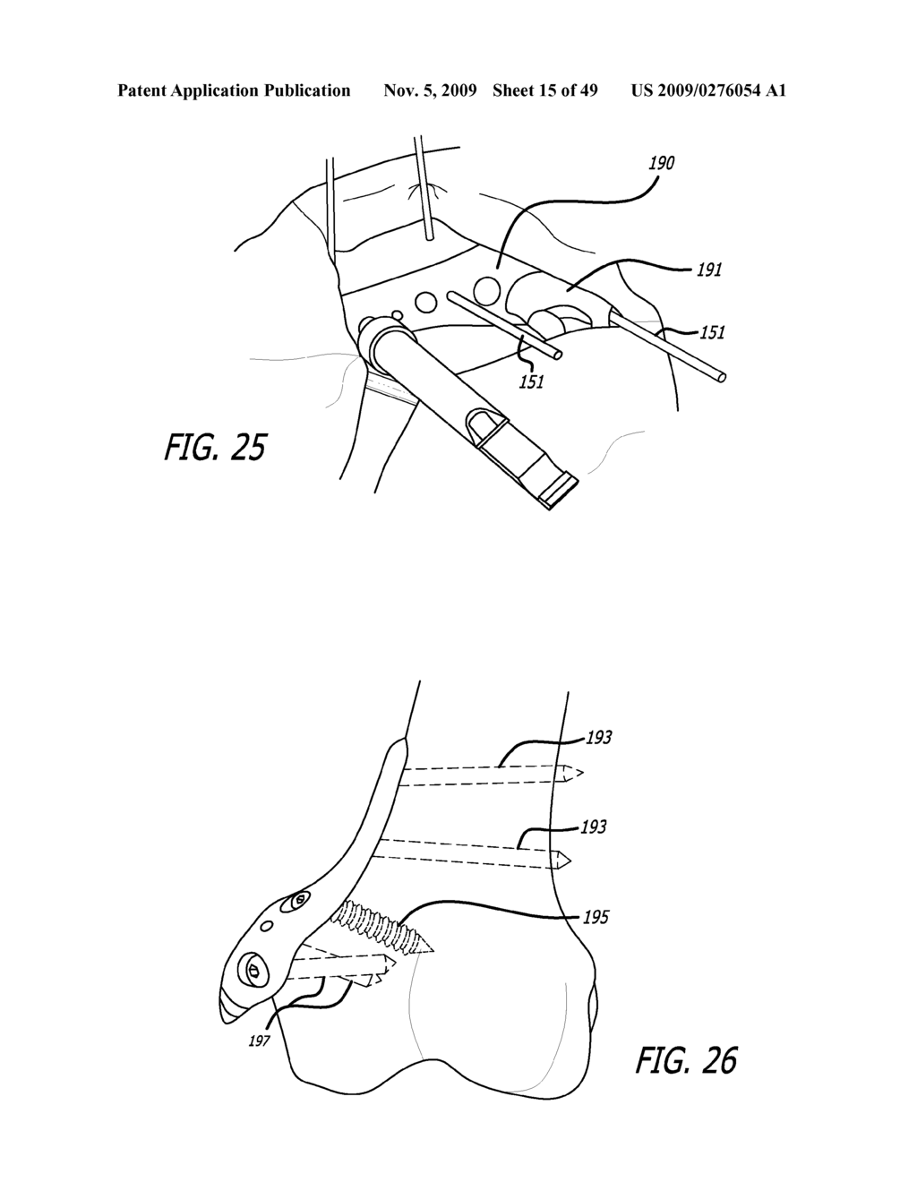 SURGICAL IMPLANTATION METHOD AND DEVICES FOR AN EXTRA-ARTICULAR MECHANICAL ENERGY ABSORBING APPARATUS - diagram, schematic, and image 16