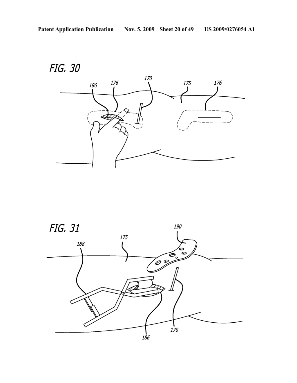 SURGICAL IMPLANTATION METHOD AND DEVICES FOR AN EXTRA-ARTICULAR MECHANICAL ENERGY ABSORBING APPARATUS - diagram, schematic, and image 21