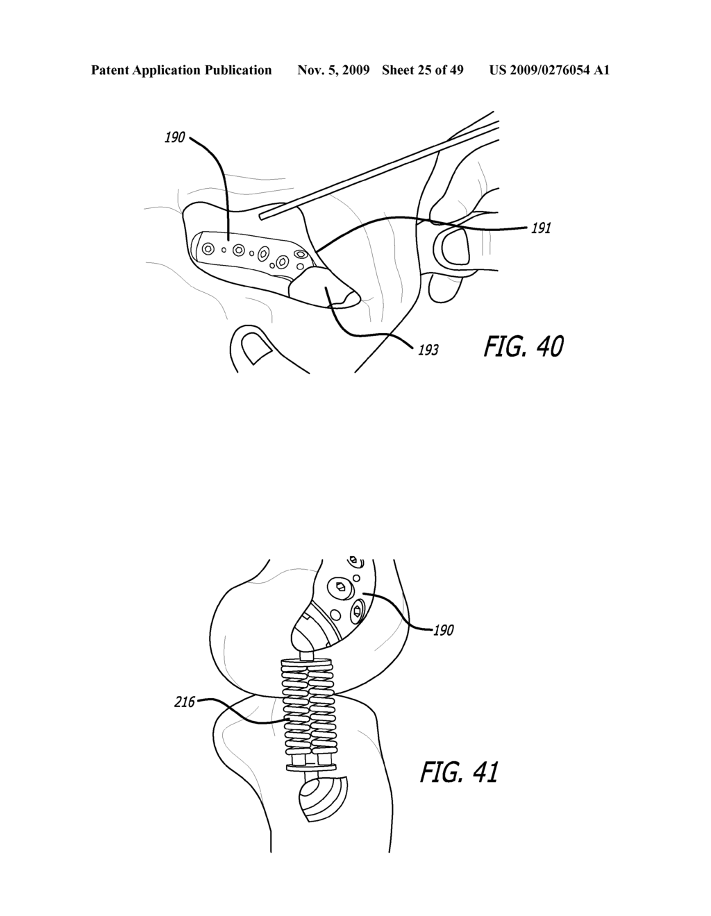 SURGICAL IMPLANTATION METHOD AND DEVICES FOR AN EXTRA-ARTICULAR MECHANICAL ENERGY ABSORBING APPARATUS - diagram, schematic, and image 26