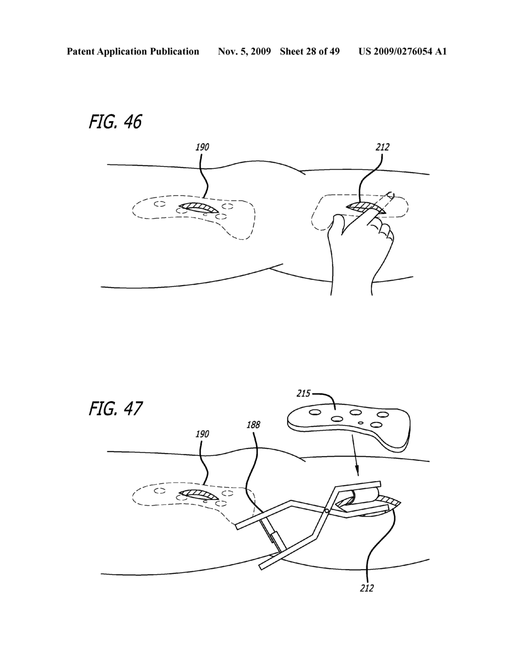 SURGICAL IMPLANTATION METHOD AND DEVICES FOR AN EXTRA-ARTICULAR MECHANICAL ENERGY ABSORBING APPARATUS - diagram, schematic, and image 29