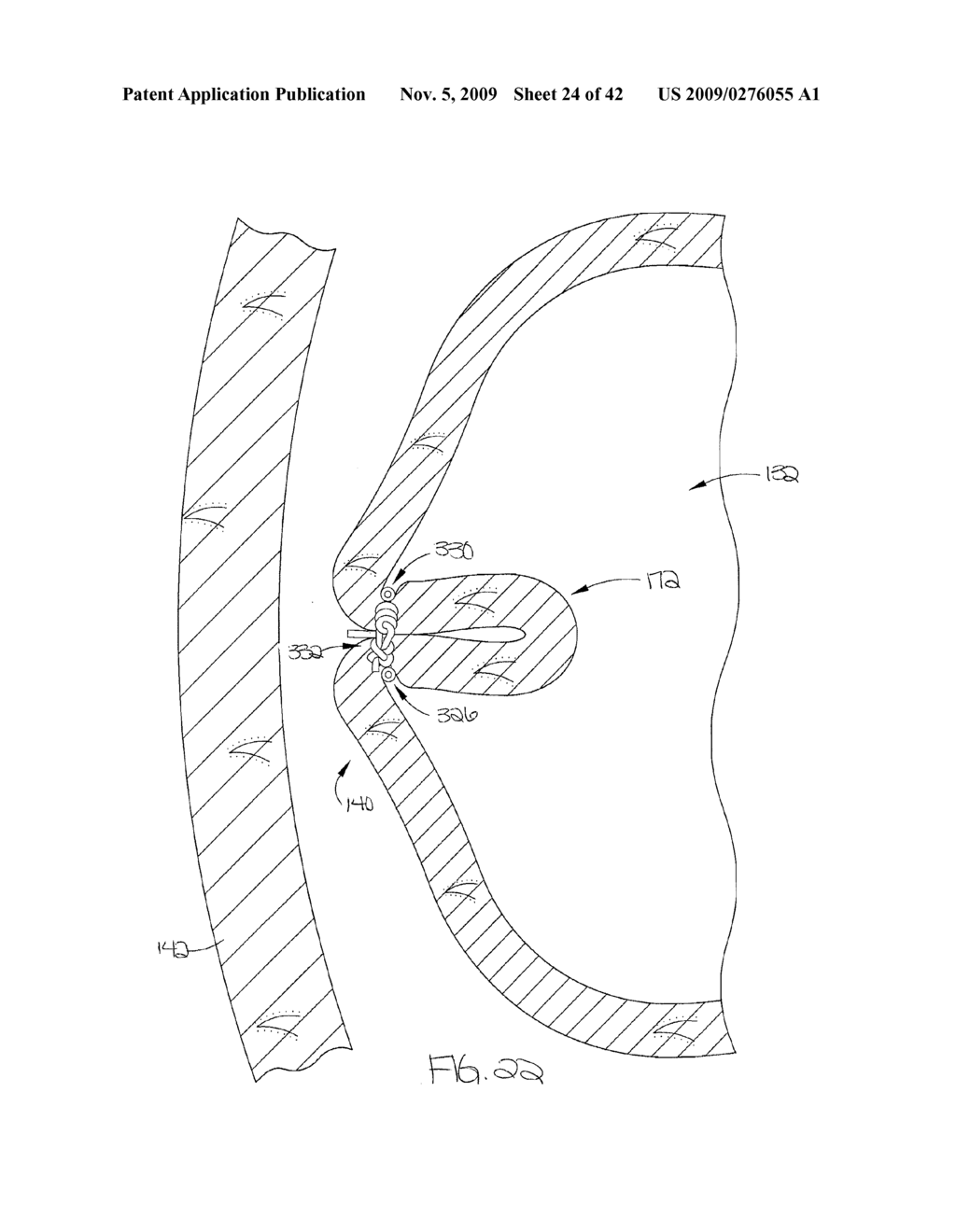 METHOD FOR GASTRIC VOLUME REDUCTION SURGERY - diagram, schematic, and image 25