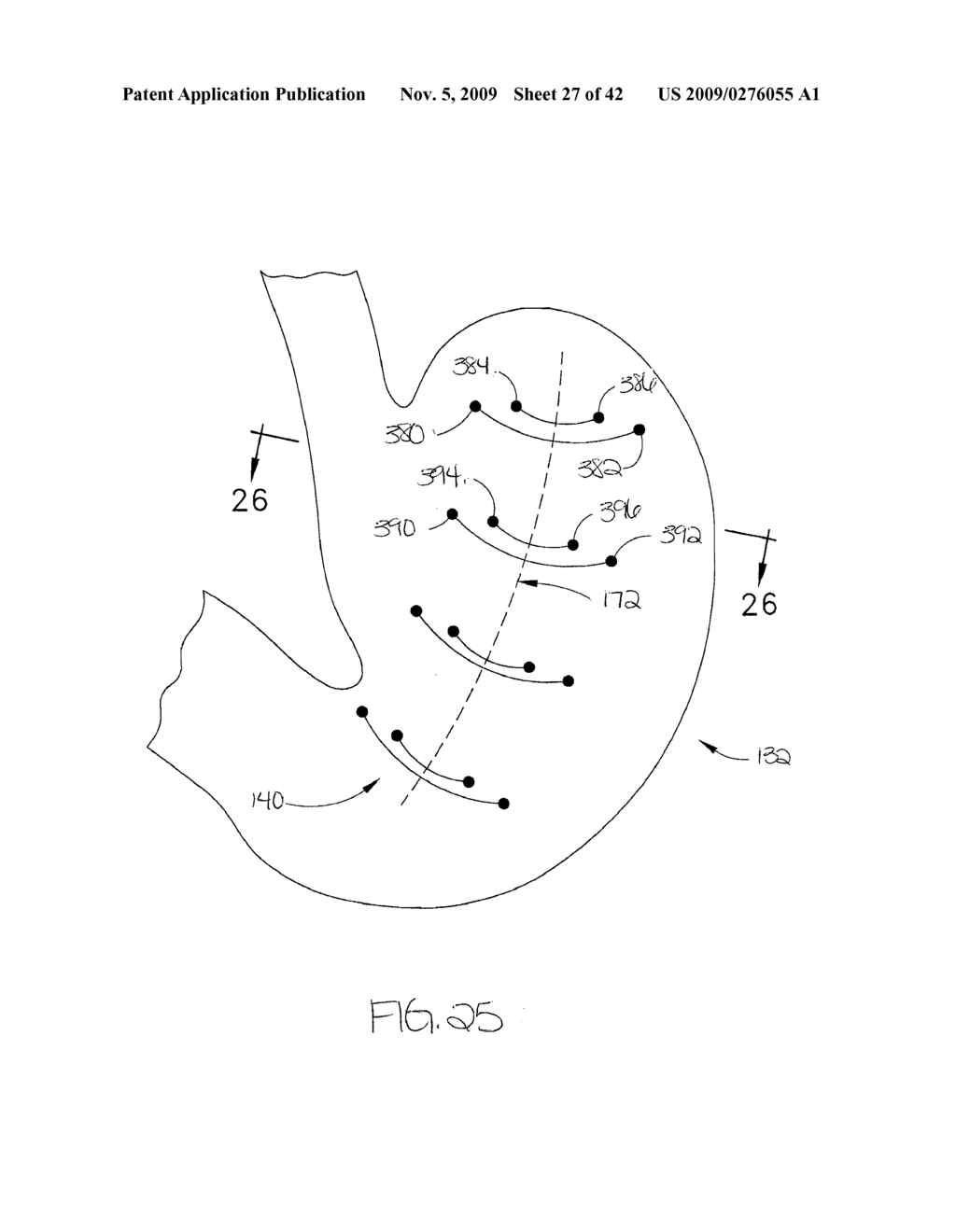 METHOD FOR GASTRIC VOLUME REDUCTION SURGERY - diagram, schematic, and image 28