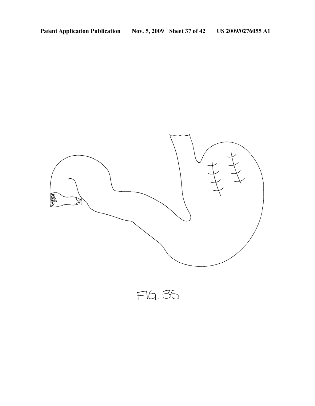 METHOD FOR GASTRIC VOLUME REDUCTION SURGERY - diagram, schematic, and image 38