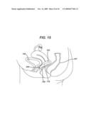 ADJUSTABLE VAGINAL SPLINT FOR PELVIC FLOOR SUPPORT diagram and image